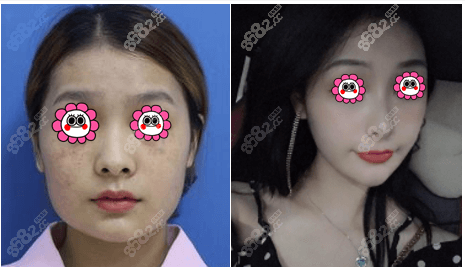 桂林华美激光祛斑案例效果参考