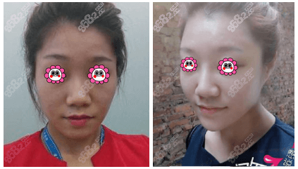 桂林星范注射隆鼻案例效果参考