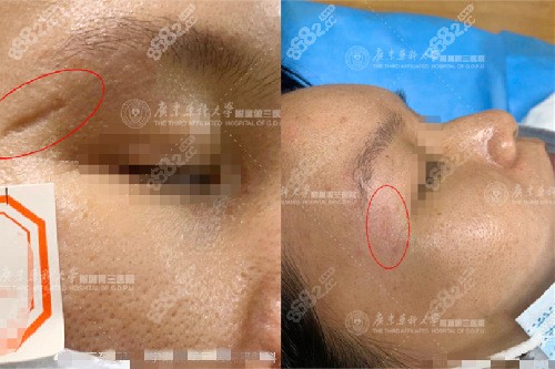 广东药科大学附属第三医院皮肤科凹陷性疤痕修复