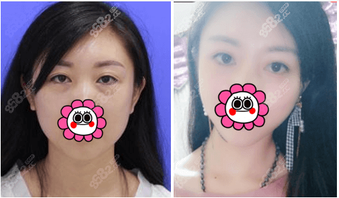 桂林星范内切祛眼袋案例效果参考