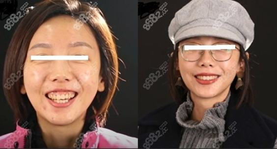 舌侧隐形矫正效果图