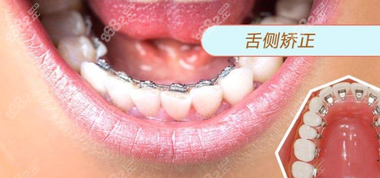 舌侧矫治器在舌内侧安装，全隐形
