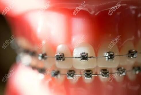 金属托槽牙齿矫正
