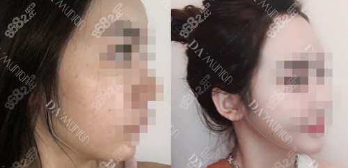 上海美联臣下颌角手术前后对比