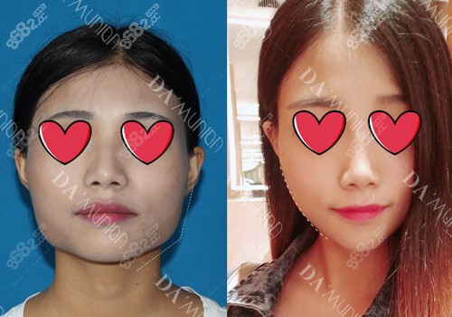 上海美联臣下颌角手术前后对比