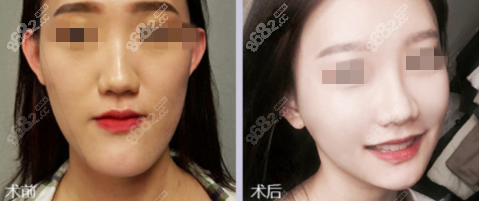 广州医科大学附属口腔医院医疗美容科正颌案例