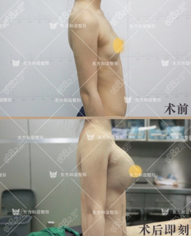 纯脂冯斌医生自体脂肪隆胸<span style=
