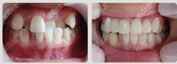 常州美奥口腔牙齿矫正前后对比图片