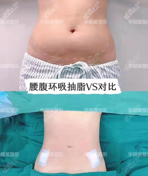 青岛华颜美孙好杰腰腹吸脂真人案例