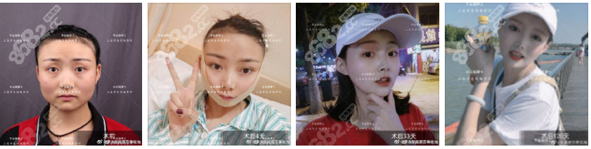 上海华美李志海磨骨审美超级好