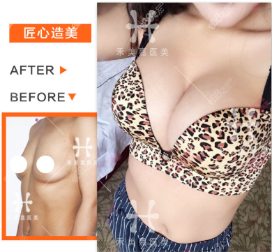 北京禾美嘉任学会自体丰胸<span style=