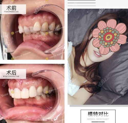 寧波鄞州藝星時(shí)代整形口腔醫(yī)院牙齒矯正真人案例 寧波鄞州藝星時(shí)代整形口腔醫(yī)院牙齒矯正真人案例