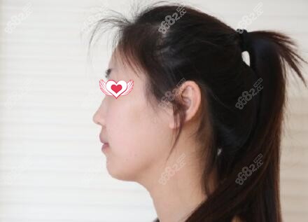 鼻整形术前侧面照