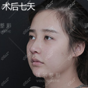 刘彦军给我做鼻子第7天了