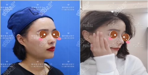 重庆联合丽格党假体隆鼻案例图