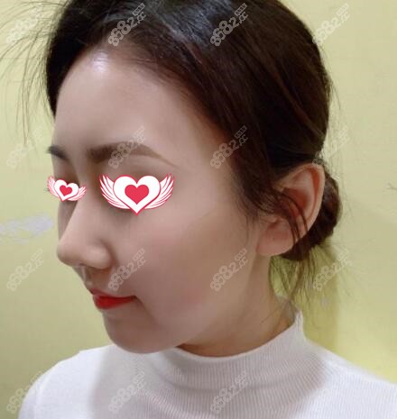 全肋软骨鼻综合术后10天效果照