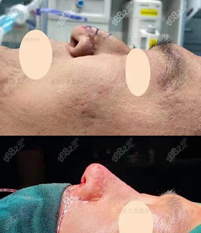 上海范荣杰鼻修复对比