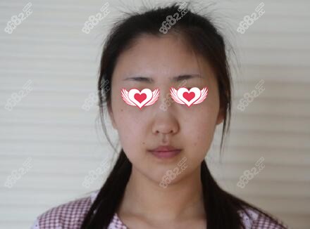 全肋软骨综合隆鼻术前照