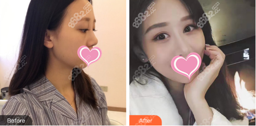 王陈鼻综合案例图