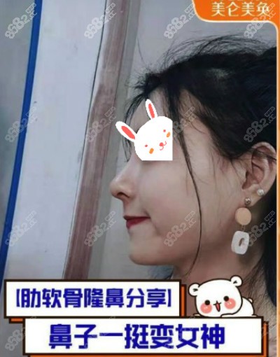 重庆美仑美奂整形 杜亚旭隆鼻