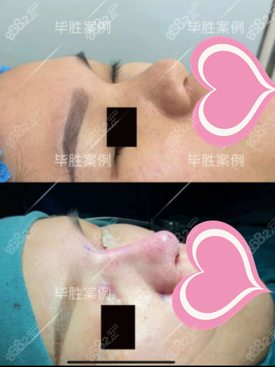 毕胜鼻修复案例图