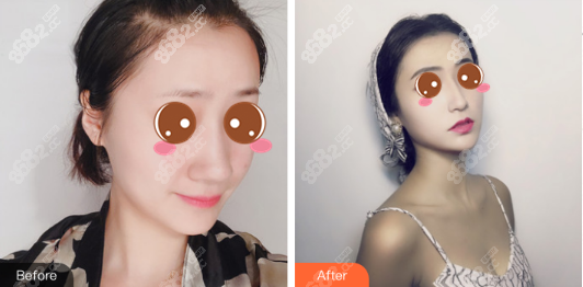林勇鼻综合案例图