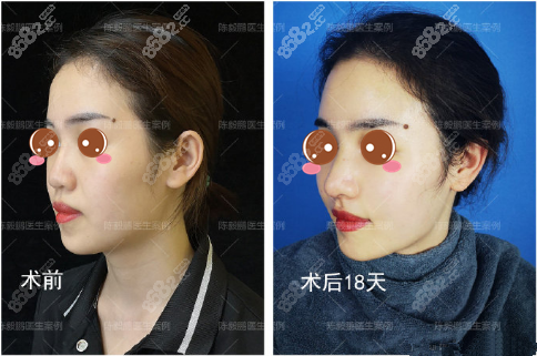 陈毅鹏超体+肋软骨鼻综合案例图