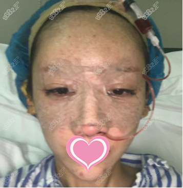 林勇鼻综合修复案例术后第三天