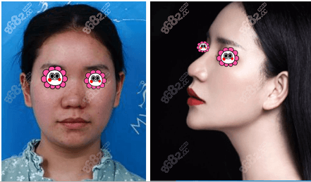 武汉美莱单喆肋骨鼻综合案例