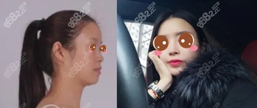 上海华美张朋医生鼻综合案例