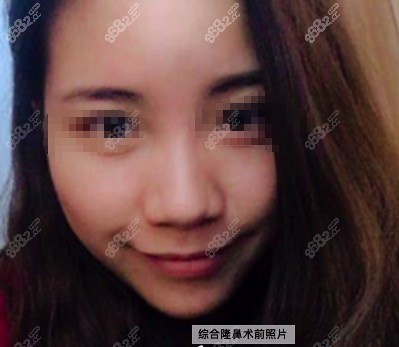 广元美华整形 董甫生 隆鼻