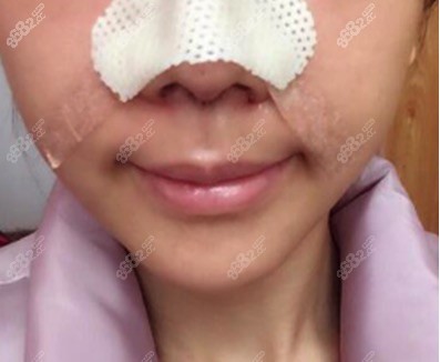 广元美华整形 董甫生 隆鼻
