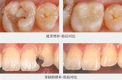 拜博口腔医院补牙效果