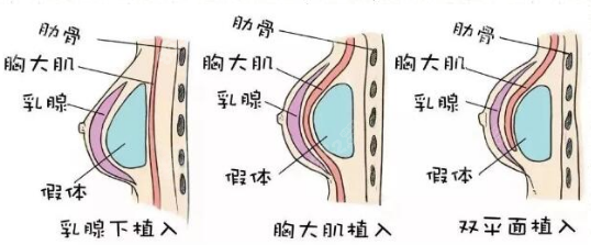 假体隆胸假体植入方式