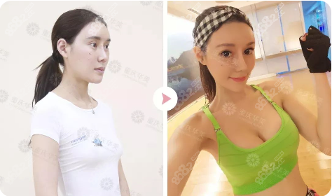 重庆华美曼托280cc假体丰胸案例图