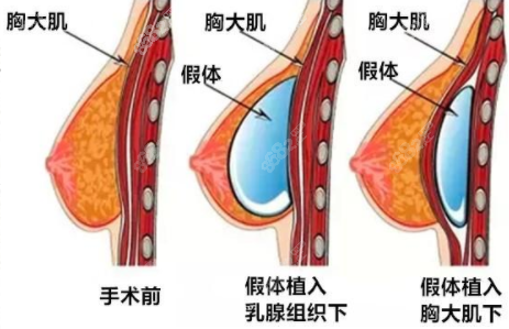 假体隆胸