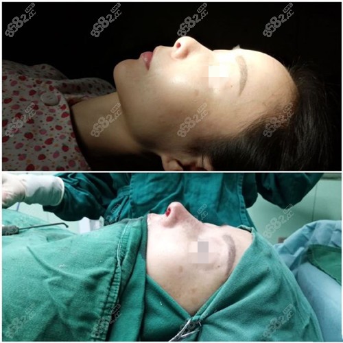 倪云志医生肋软骨鼻案例