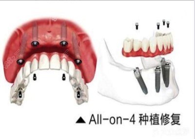 丽江种植牙选德柏口腔或锦美口腔哪家