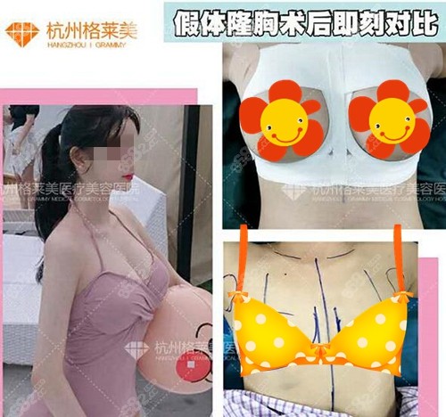 杭州格莱美假体隆胸前后对比图