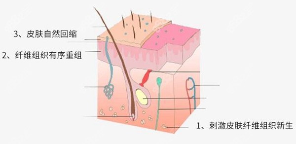 土麦森吸脂专项紧肤技术