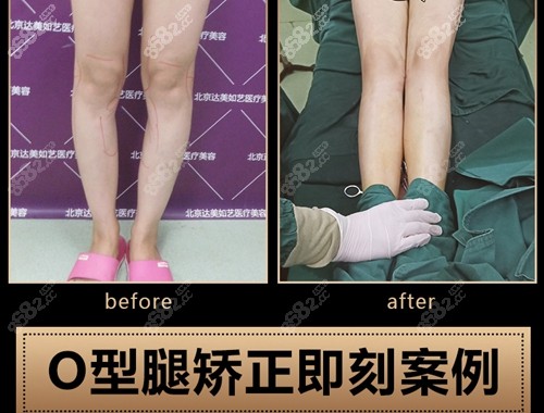 北京达美如艺医疗美容门诊部谷廷敏医生O型腿矫正案例