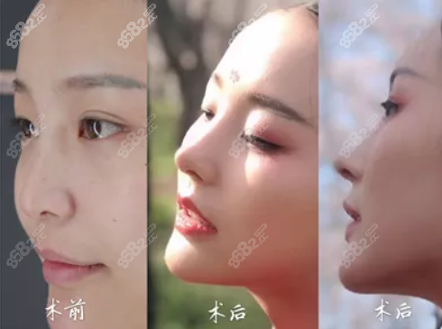 贵阳华美全肋鼻综合效果图
