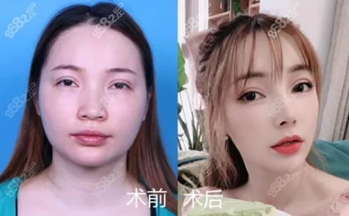 贵阳华美半肋软骨隆鼻效果图