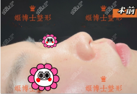 我做鼻综合手术前