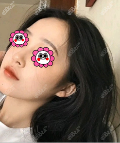 姬付康鼻综合案例效果参考