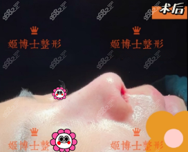 术后即刻照