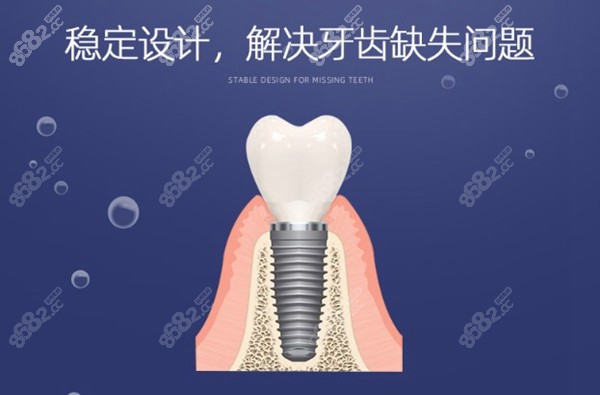 鼎植速齿半口固定种植牙