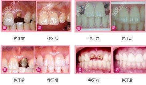 口腔种植牙案例效果图汇总