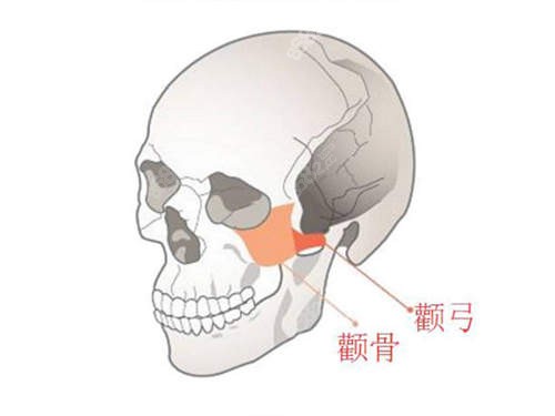 上海轮廓手术 模型图