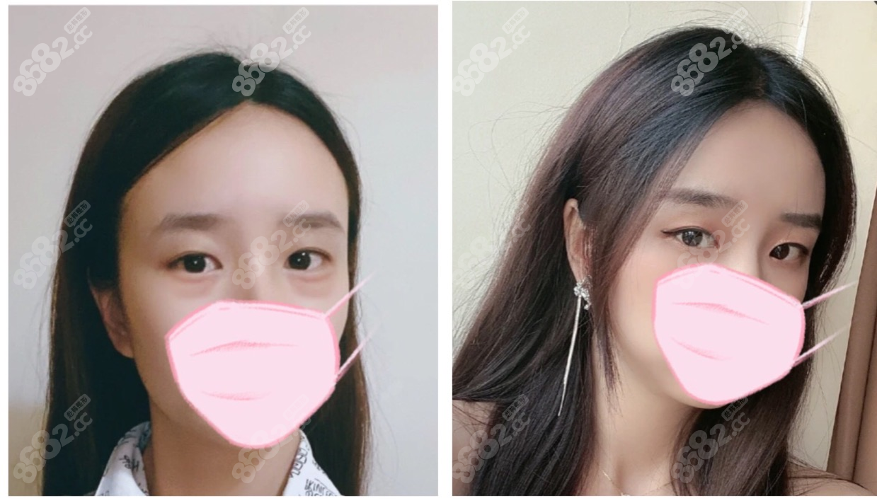 常州博仕不开刀祛眼袋案例对比图